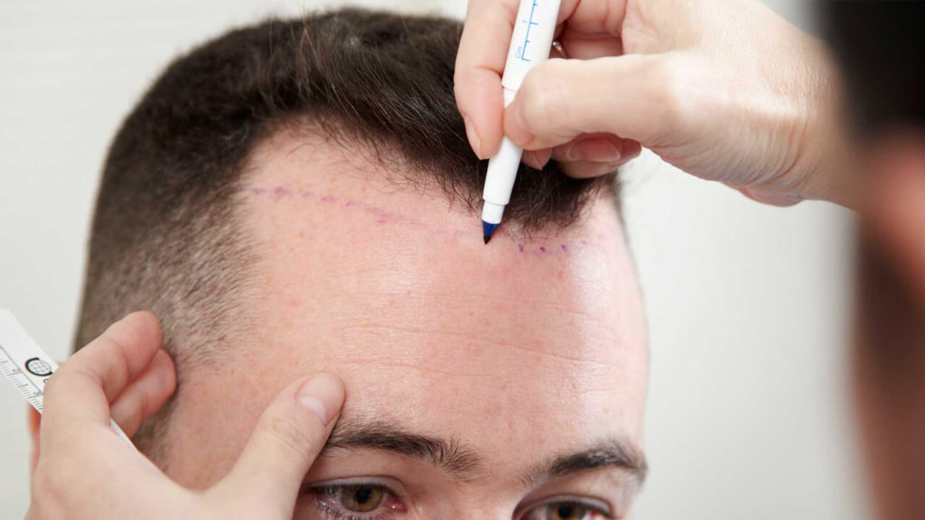 hair transplant